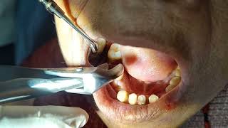 Root Piece Extraction With Detail Explanation 1st Pre Molar and 1st Molar  Multiple Extraction [upl. by Marra575]