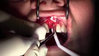 Extraction 9 with GBRSocket Grafting Membrane Use and Bone Fill II [upl. by Previdi558]