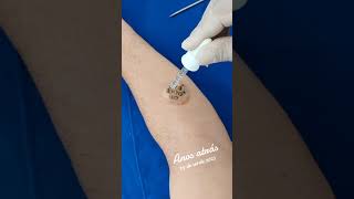 Botfly Maggot Removal spa doctor satisfying pimple removal [upl. by Carrissa]