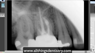 Endodontic Perforation  Hints to help you when it happens to you [upl. by Ikilisav]