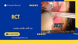 Root Canal Treatment [upl. by Liz]