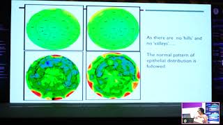 HEALING OF EPITHELIUM AND ITS IMPACT ON REFRACTIVE SURGERY DR CHINTAN MALHOTRA [upl. by Sices808]