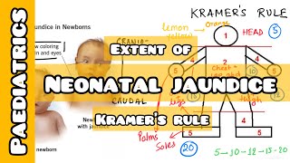 How to asses extent of Neonatal Jaundice by Kramer’s Rule  USMLE NEET PG INICET NCLEX [upl. by Onurb]