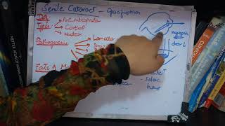 SENILE CATARACT very IMPORTANT topic ade simple part 2 [upl. by Aleen]