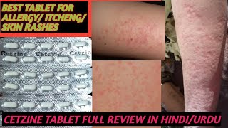 BEST TABLET FOR ALLERGY AND SKIN RASHES AND ITCHINGCETZINE TABLET FULL REVIEW IN HINDIURDU [upl. by Wymore]