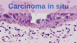 What is Carcinoma in situ  Pathology mini tutorial [upl. by Nogem]