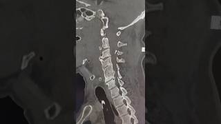 Ct Scan Showing Multiple Cervical Fractures ctscan radiology [upl. by Pedro]