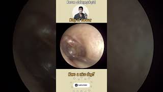 고막염증제거 otitismedia needle aspiration satisfyingvideo ENT [upl. by Curtis]