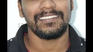 Teeth Gap Closure In Chennai  Affordable Self Ligating Braces Treatement  DrMKP Invisalign Clinic [upl. by Ahael]