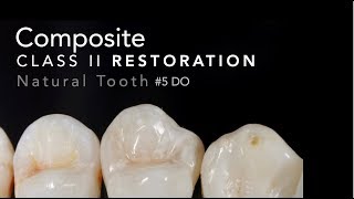 Class II Composite Restoration  5 DO Natural Tooth [upl. by Ardnas]