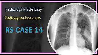 FRCR Radiology RS ases 14 A 60 yrs old patient presented with productive cough for 2 weeks [upl. by Yenreit]