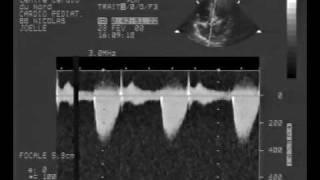 echocardiogrammultiple rhabdomyoma tumor cw doppler [upl. by Oicnedif]