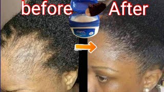 Mix Vaseline and Coffee for Extraordinary Hair Growth [upl. by Anoyi]