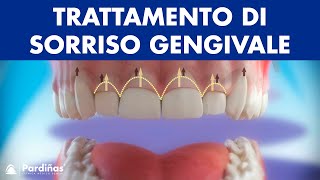 Gengivectomia  Trattamento di sorriso gengivale © [upl. by Zielsdorf]