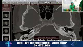 Preoperative CT scan in Otosclerosis Points to consider Prof Dr Delwar Hossain [upl. by Corrinne]