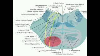 Millard Gublar syndrome [upl. by Reiche]