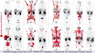 Theranostics Successfully Combining Diagnostics and Cancer Treatment  The Science of Healing CLIP [upl. by Aerdied]