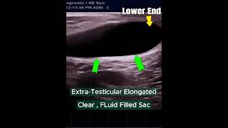 Ultrasound Infantile HYDROCELE  Newborn Baby baby babyboy hydrocele [upl. by Nerrag]