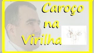 Caroço na virilha doutor estou preocupado [upl. by Ertha805]