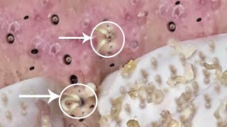 Pimple Popping 2020 Video 42 Blackheads removal Acne removal acne treatment [upl. by Koser]