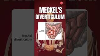 Mnemonics of Meckels diverticulum by Ms Chitra Pandey  NORCET 70 amp 80  Nursing Next Live [upl. by Tnerb]