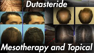 Dutasteride Topical and Mesotherapy IT WORKS [upl. by Aivataj884]