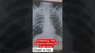 chest xray pneumonia pneumonia treatment medical doctors youtubeshorts [upl. by Ardnuasac]