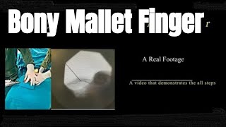 Mallet finger pinning treatment explained  Dr Kemal Gokkus [upl. by Pomona]