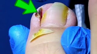 Toenail Turns Yellow After Infection Huge Ingrown Toenail Removal [upl. by Means717]