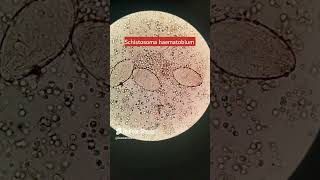 Schistosoma haematobiumSchistosomiasis parasite under microscope parasitology urinalysis [upl. by Nedah705]