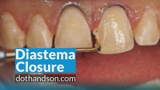 Resin Veneer and Diastema Closure by Dr Dennis Hartlieb [upl. by Otsedom]