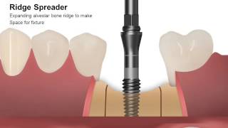 2D Manual Ridge Spreader [upl. by Arratal]