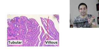 Colonic polyps quot1quot  الامتحان الطبي الموحد [upl. by Simonsen]