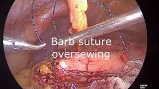 Laparoscopic excision ofGR curve stomach GIST [upl. by Licec236]