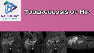 Tuberculosis of Hip [upl. by Etteyniv985]