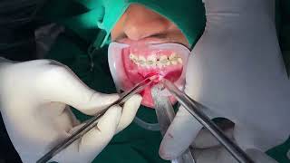 Impacted Mandibular Canine surgical removal [upl. by Glenda]