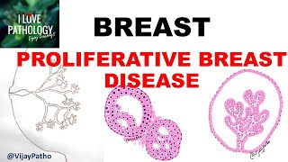 DISEASES OF BREAST Part 2 PROLIFERATIVE BREAST DISEASE [upl. by Aihsia366]