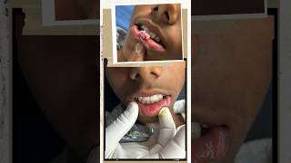 MucoceleGrannuloma pyogenic scarless surgeryHow To Remove An Oral Mucocele Lip ulcerLip lesion [upl. by Yelbmik]