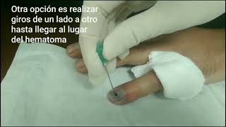 TREPANACIÓN DE LA UÑA  ¿CUÁNDO SE HACE DRENAJE DE UN HEMATOMA SUBUNGUEAL [upl. by Maurili]