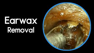 The Best Earwax Removal Video Of This Week [upl. by Araik47]