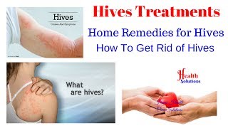 How to treat hives  Hives Treatments  Home Remedies for Hives [upl. by Inaluahek735]