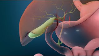 Surgery to Remove Your Gallbladder Open Cholecystectomy [upl. by Rudd720]