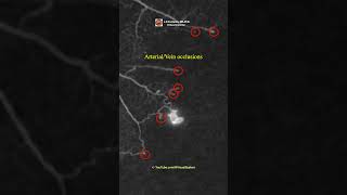 Proliferative Diabetic Retinopathy [upl. by Arvo]