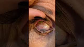 Doctor Removes 23 Contact Lenses From Patients Eye [upl. by Enilhtak558]