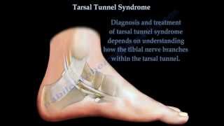 Tarsal Tunnel Syndrome  Everything You Need To Know  Dr Nabil Ebraheim [upl. by Radman]