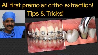 Ortho all premolar extraction technique sequence complications Extraction lecture by DrMurugavel [upl. by Graubert177]