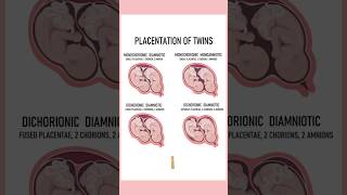 4 Types of twins medically Twin pregnancies pregnant youtubeshorts twins September 4 2024 [upl. by Eaned]