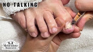 Tricky Ingrown Toenail Trim ASMR nails satisfying asmr [upl. by Wack]