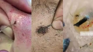 Super Satisfying Ingrown Hair Removal💚Ingrown Hair Removal 2022💚TiKTok Compilation [upl. by Sou]