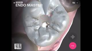 Maxillary First Molar Access OpenDental EndoMaster [upl. by Emmalynne]